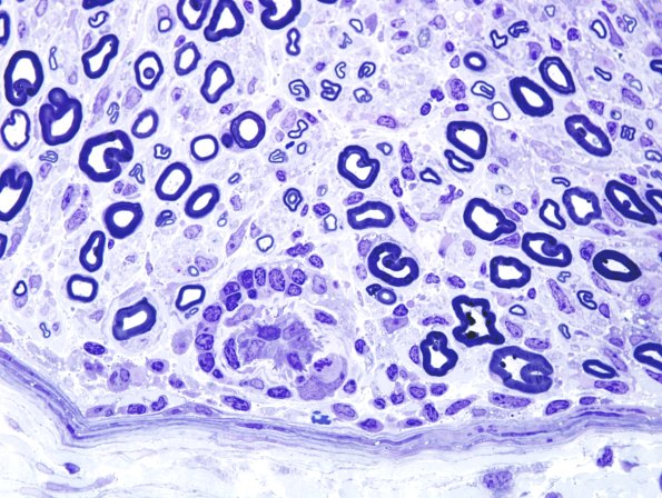 8A4 GBS (Case 8) Plastic 9