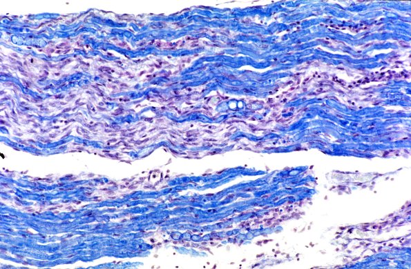 9A1 GBS, (Case 9) LFB-PAS 1