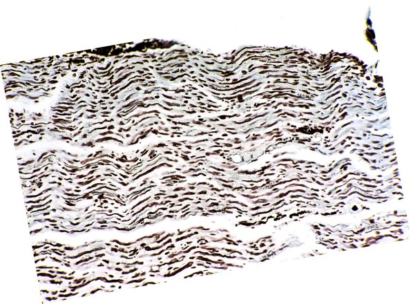9A2 GBS, (Case 9) Bodian 1