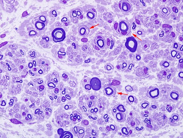 10A1 CIDP (Case 10) Plastic 1 copy.jpg