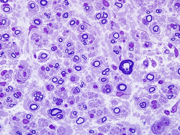 10A2 CIDP (Case 10) Plastic 2.jpg