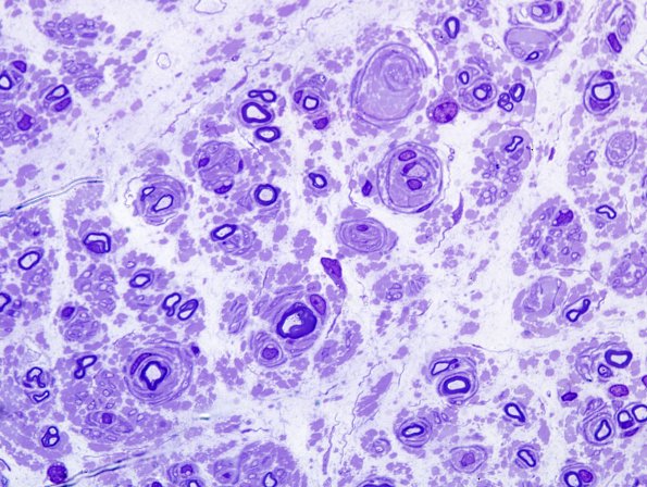 10A3 CIDP (Case 10) Plastic 2.jpg