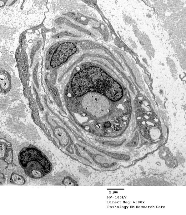 10B2 Paraprotein (Case 10)_028 - Copy