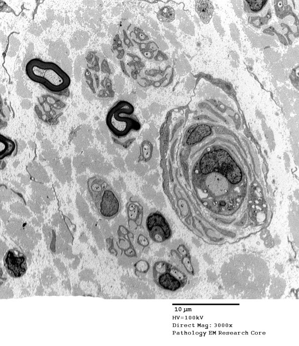 10B3 CIDP (Case 10) EM 027 - Copy