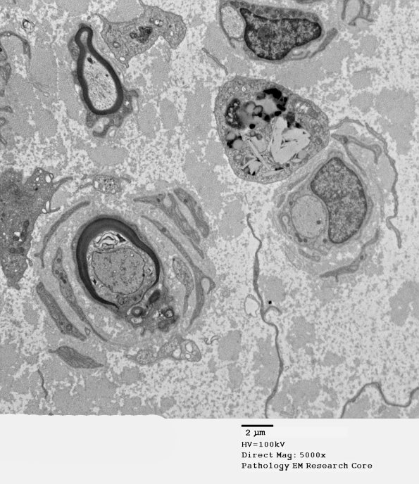 10B4 CIDP (Case 10 EM 018 - Copy