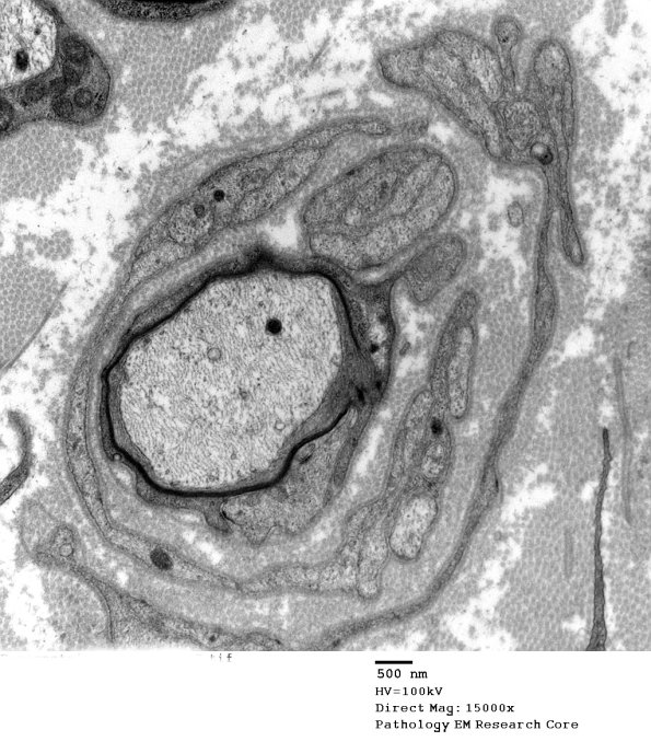 10B6 Paraprotein (Case 10)_035 - Copy