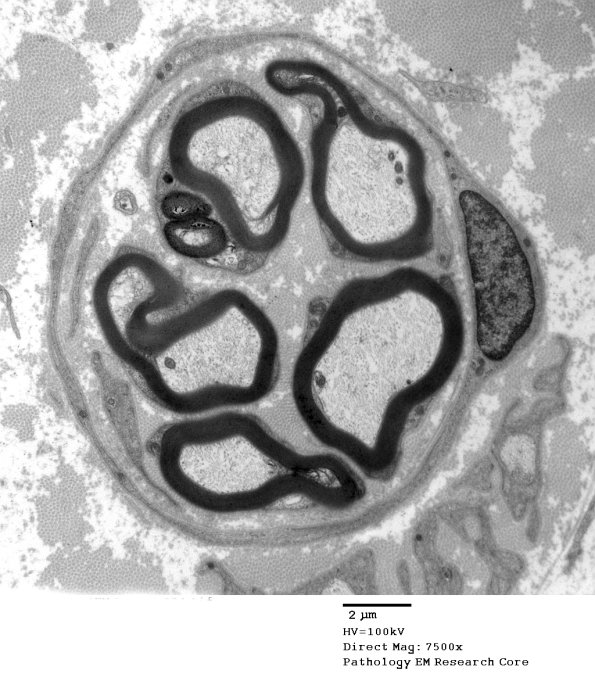10B7 Paraprotein (Case 10)_034 - Copy