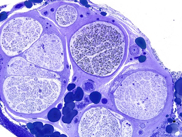 11A1 CIDP (Case 11).jpg