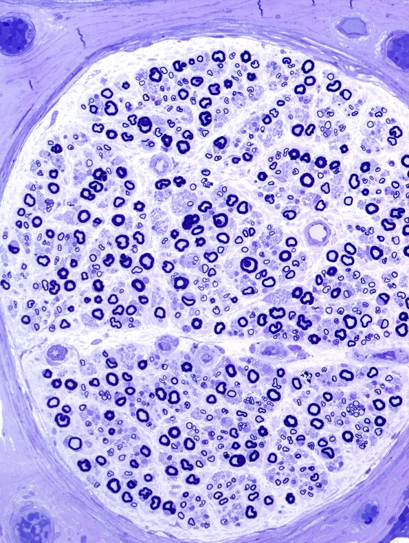 11A2 CIDP (Case 11).jpg