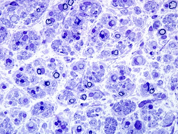 1A3 CIDP (Case 11) (4).jpg