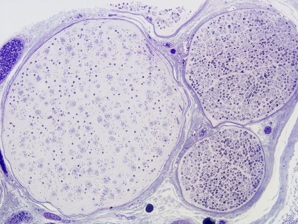 12A2 CIDP (Case 12) Plastic 13