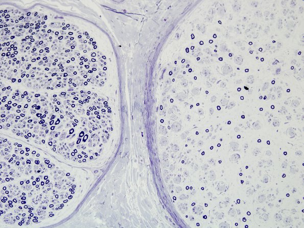 12A3 CIDP (Case 12) Plastic 7