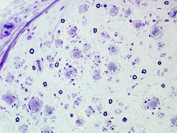 12A5 CIDP (Case 12) Plastic 20