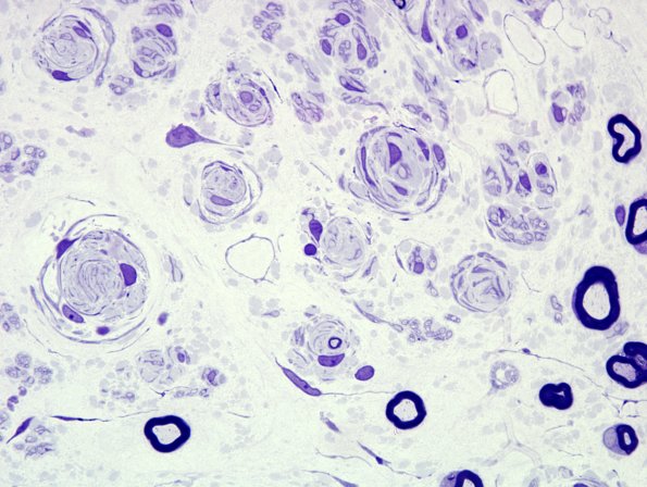 12A6 CIDP (Case 12) Plastic 4