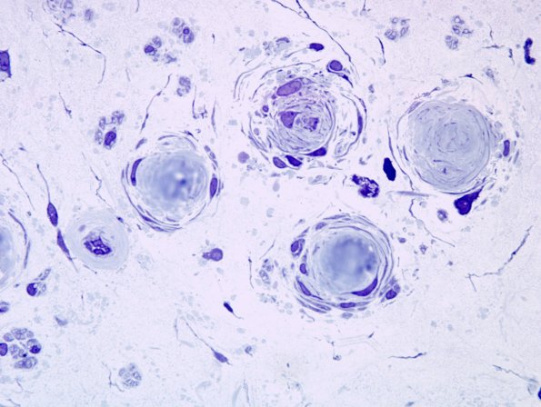 12A8 CIDP (Case 12) Plastic 23