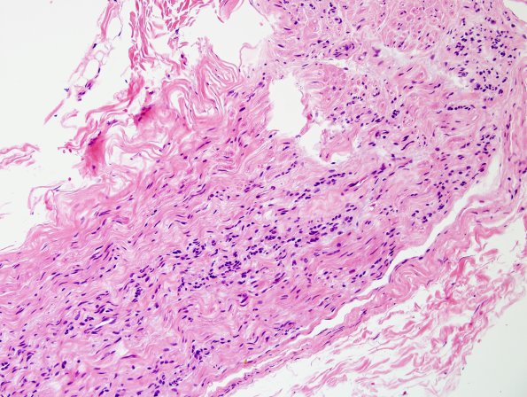 13A1 CIDP (Case 13) H&E 20X 2.jpg