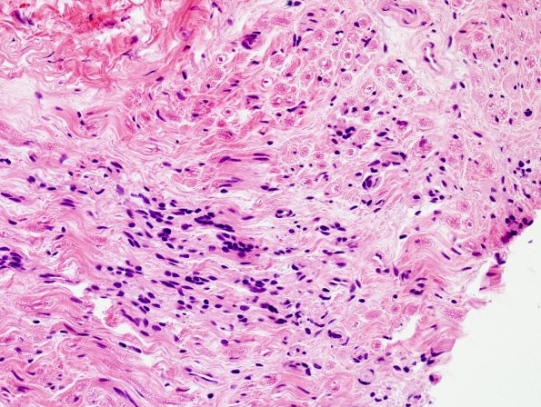 13A2 CIDP (Case 13) H&E 40X 2.jpg