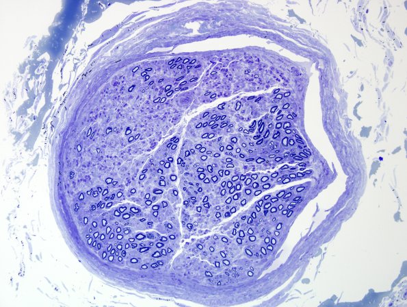 13B1 CIDP (Case 13) 20X.jpg
