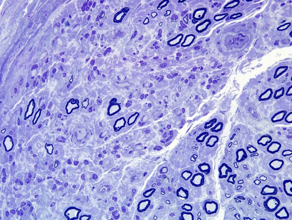 13B3 CIDP (Case 13) 60X.jpg