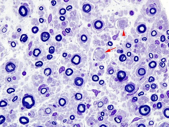 14A1 CIDP (Case 14) Plastic 7 copy