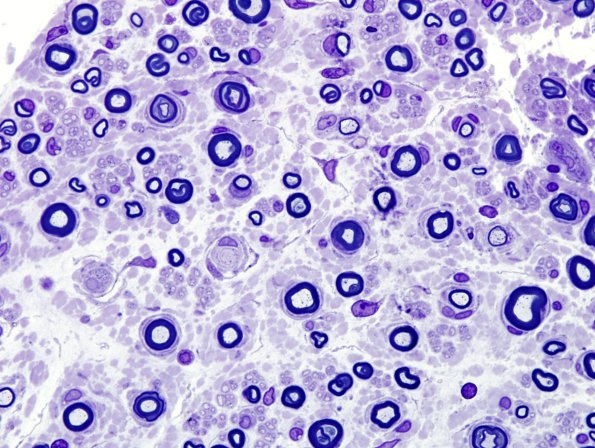 14A2 CIDP (Case 14) Plastic 5