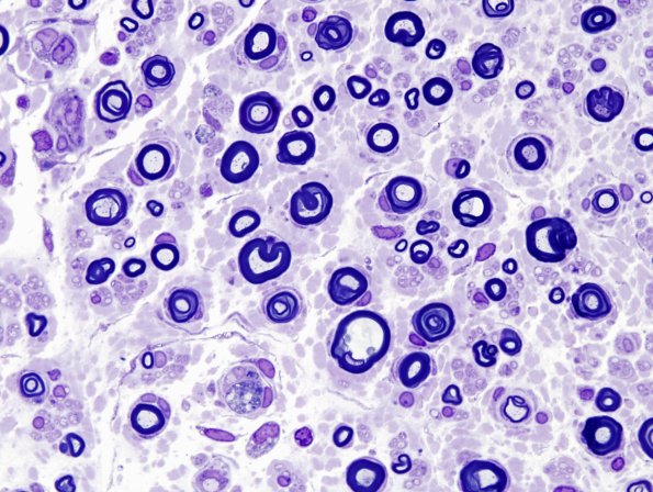 14A3 CIDP (Case 14) Plastic 3