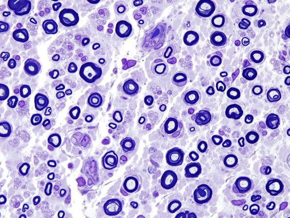 14A4 CIDP (Case 14) Plastic 6