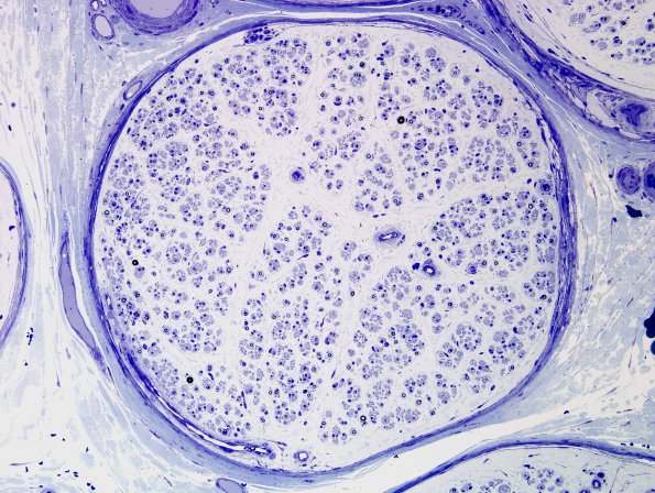 15A1 CIDP (Case 15) Plastic 3
