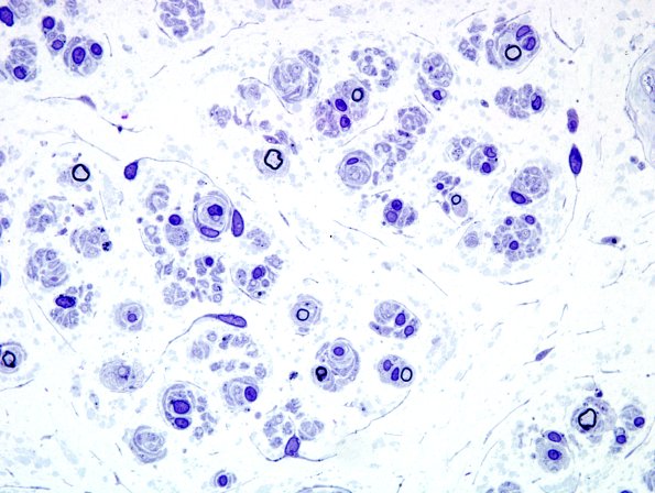 15A2 CIDP (Case 15 Plastic 2