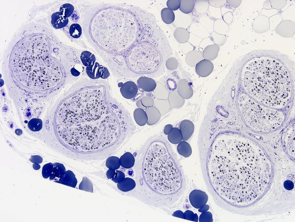 16A1 CIDP Case 16 Plastic 1