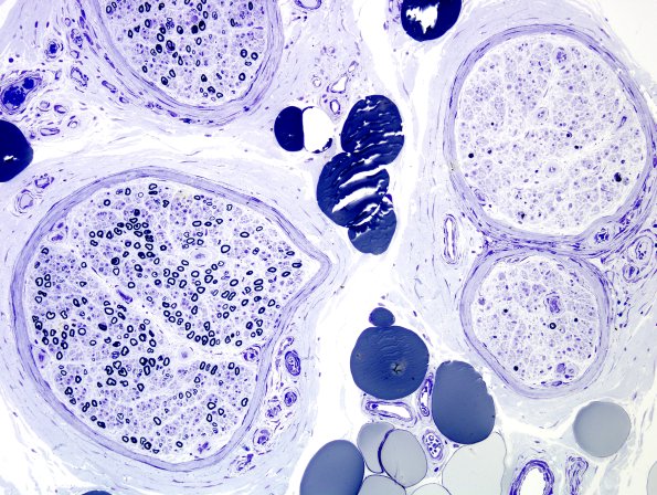 16A2 CIDP Case 16 Plastic 2