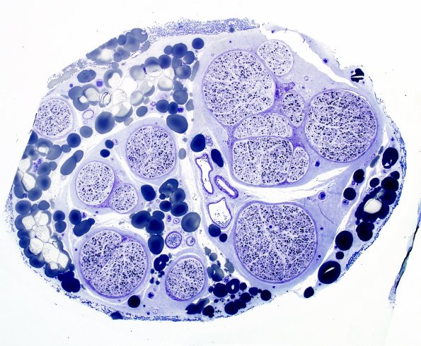 17A1 CIDP (Case 17i) Plastic 10