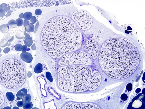 17A2 CIDP (Case 17 Plastic 1