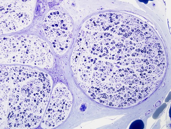 17A3 CIDP (Case 17) Plastic 3