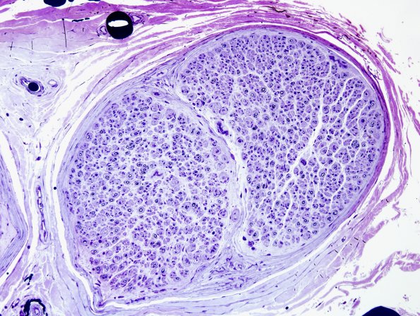18A1 CIDP (Case 18) Plastic 2.jpg