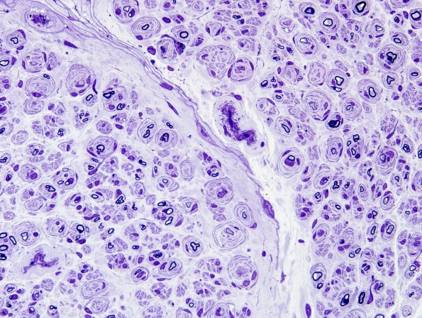 18A2 CIDP (Case 18) Plastic 4.jpg