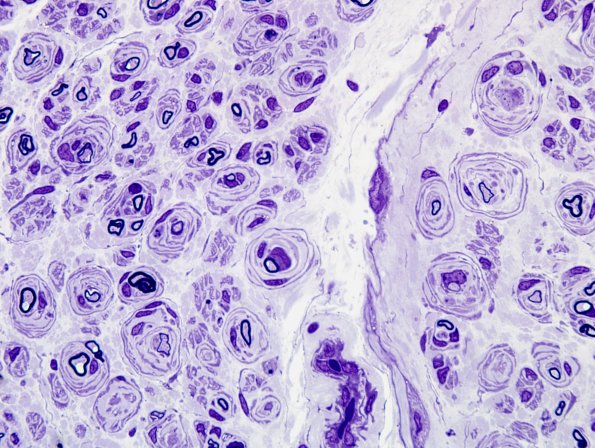 18A3 CIDP (Case 18) Plastic 5.jpg