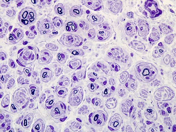 18A4 CIDP (Case 18) Plastic 7.jpg