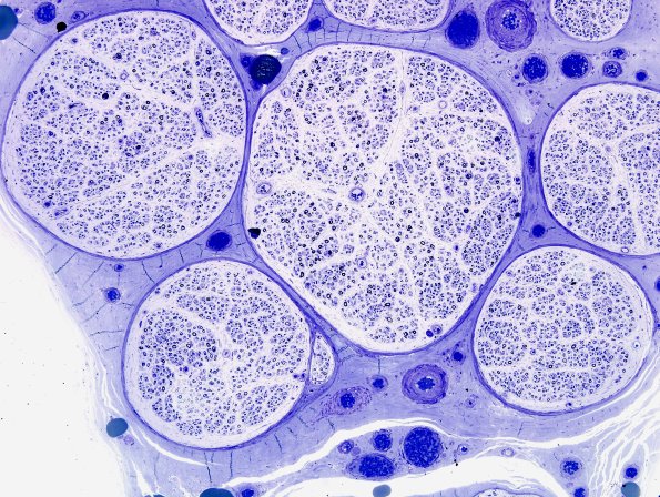 19A1 CIDP (Case 19) Plastic 9