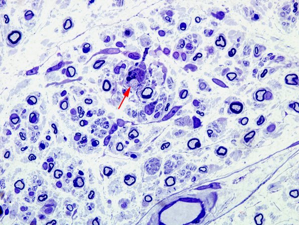 19A2 CIDP (Case 19) Plastic 2A copy