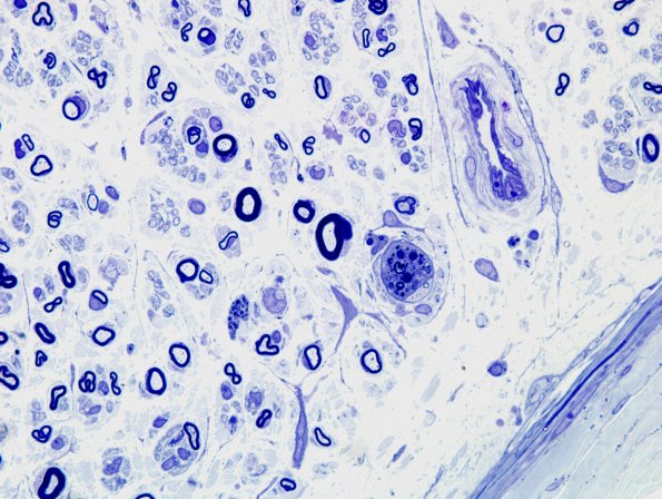 19A3 Fig 9-14 CIDP (Case 19) Plastic 3