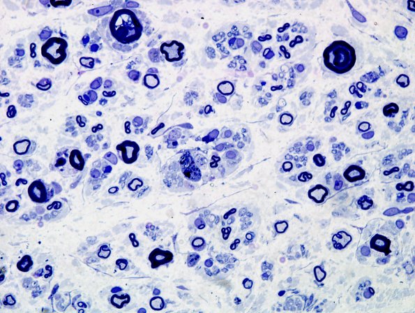 19A4 CIDP (Case 19) Plastic 1A