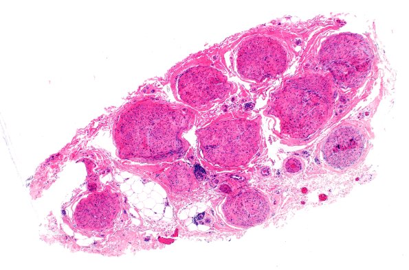 1A1 CIDP (Case 1) H&E 4X