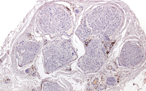 1B1 CIDP (Case 1) CD45 10X
