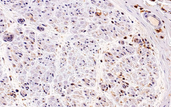 1B2 CIDP (Case 1) CD45 40X 2