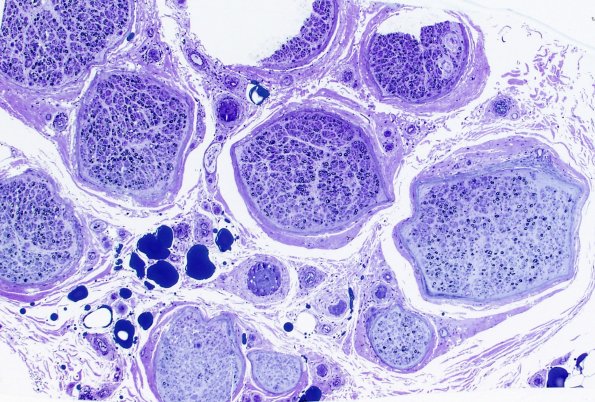 1C1 CIDP (Case 1) Plastic 8 4X