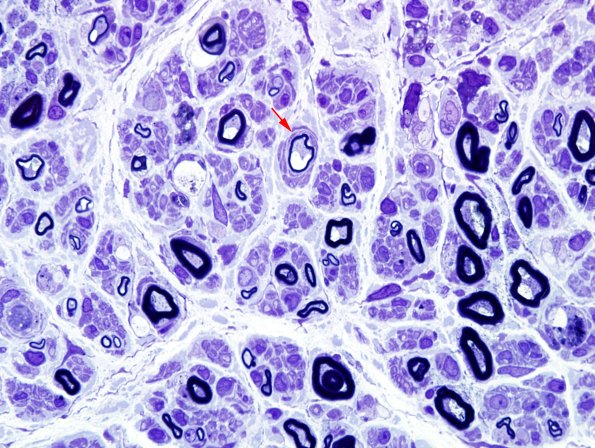 1C10 CIDP (Case 1) Plastic 21 copy