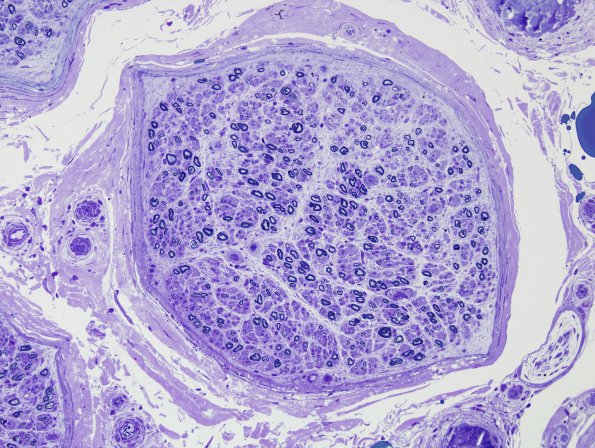 1C2 CIDP (Case 1) Plastic 8A 20X