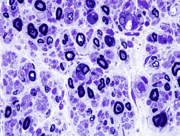 1C3 CIDP (Case 1) Plastic 4.jpg