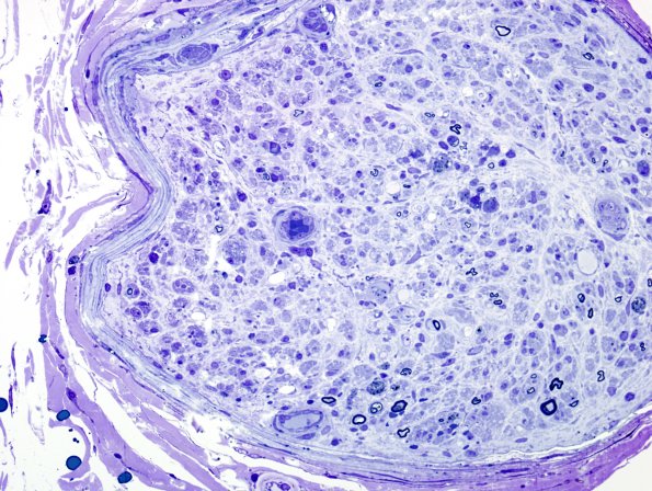 1C5 CIDP (Case 1) Plastic 3A